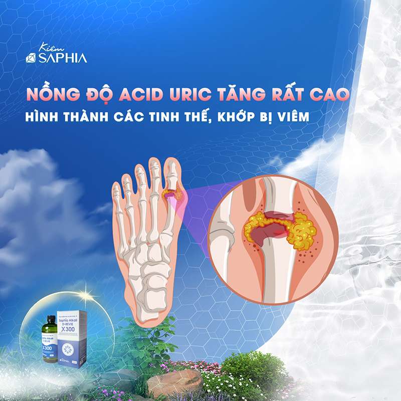 Sử dụng nước Kiềm thảo dược Saphia giúp đẩy lùi nguy cơ mắc bệnh Gout