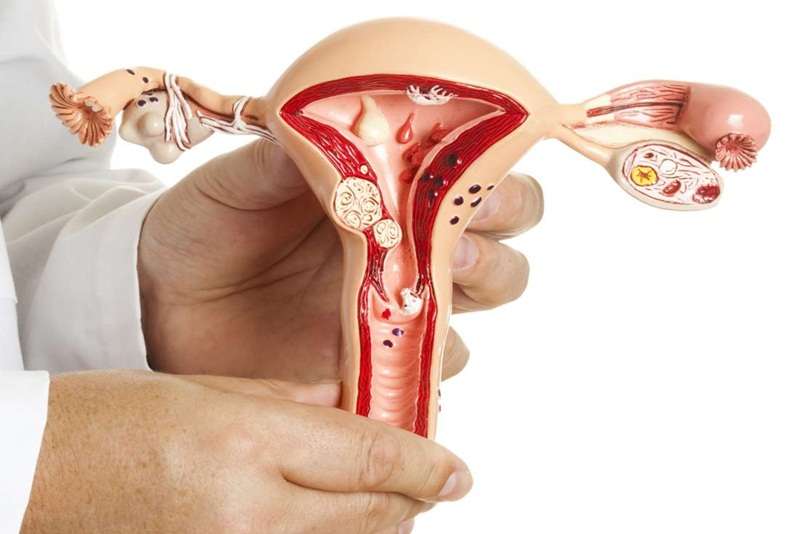 U xơ tử cung có thể được điều trị hiệu quả nếu phát hiện sớm và can thiệp kịp thời