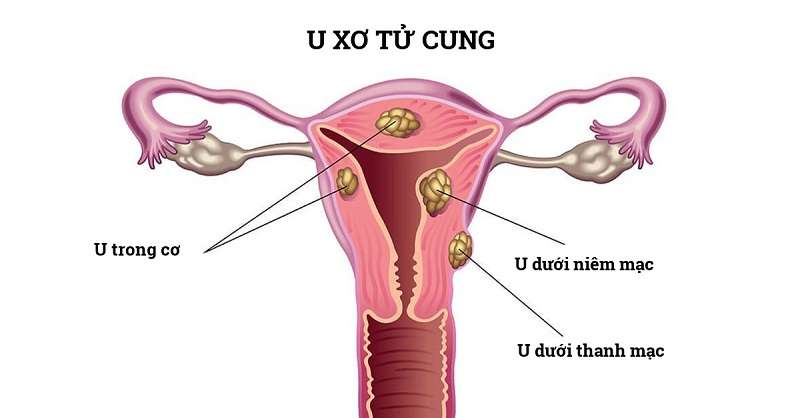 U xơ tử cung là bệnh phổ biến ở phụ nữ trong hoặc sau độ tuổi sinh sản
