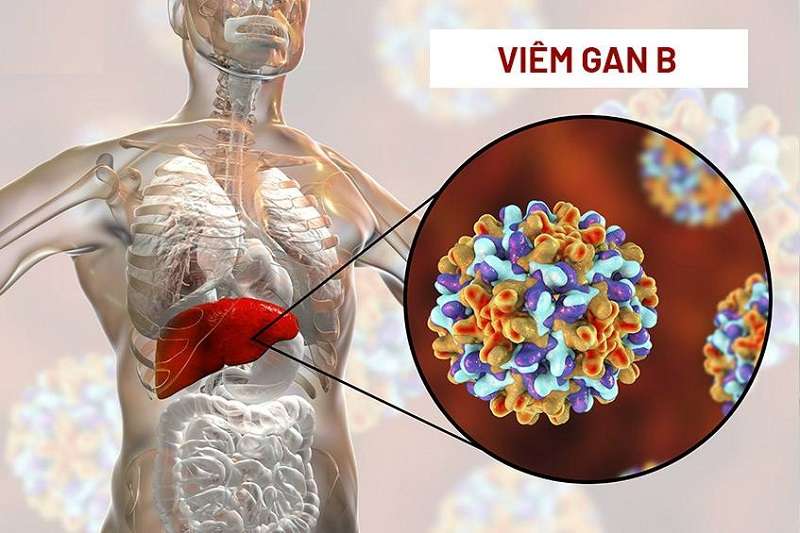 Viêm gan B là bệnh nhiễm trùng gan do virus viêm gan B (HBV) gây ra