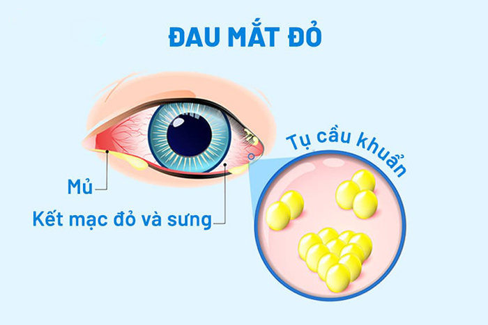 Thông tin về bệnh đau mắt đỏ