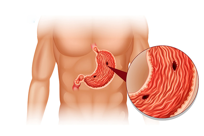 Biến chứng viêm loét dạ dày gây tử vong nếu chủ quan