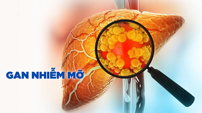 Tại sao độ tuổi bị gan nhiễm mỡ càng ngày càng trẻ hóa?