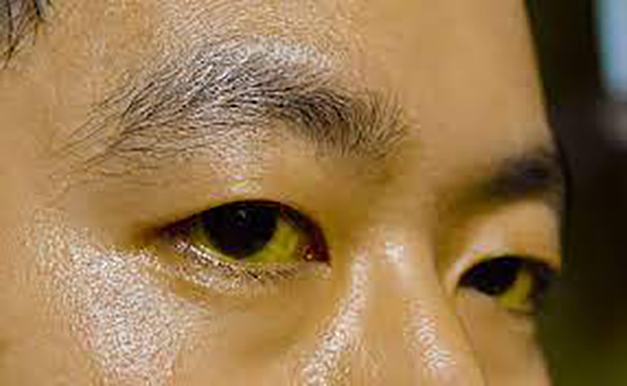 5 dấu hiệu trên mặt cảnh báo bệnh gan có thể bạn không để ý