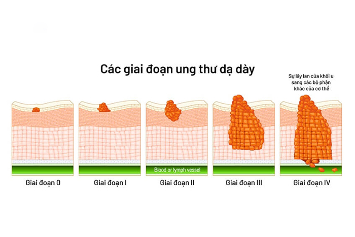 Điều cần biết về ung thư dạ dày: nguyên nhân và cách phòng tránh