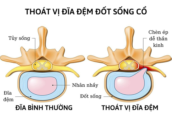 Thoát vị đĩa đệm và những hệ lụy nguy hiểm của nó?