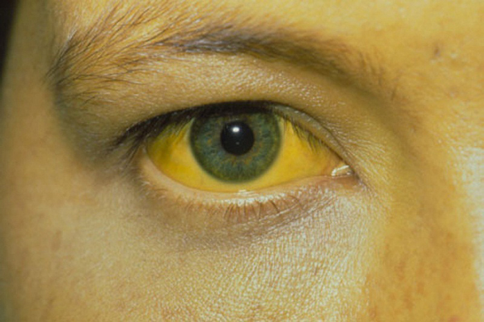 vàng mắt