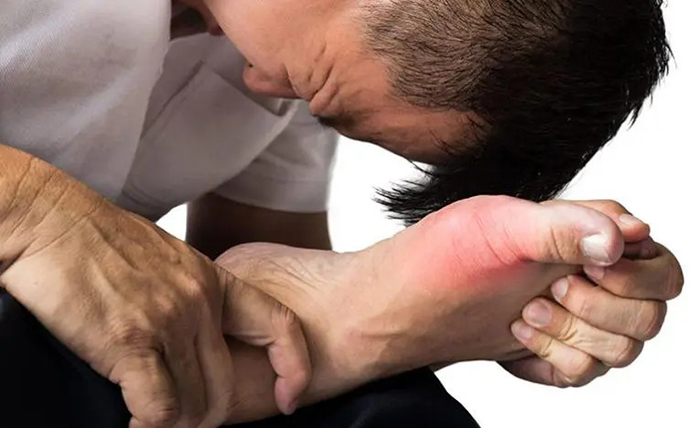 Phân biệt Gout và giả gout: Cách điều trị cho 2 căn bệnh