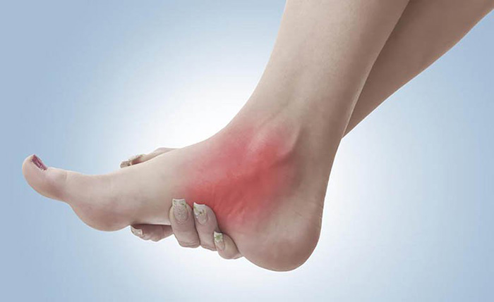 Bệnh gout là gì? Cách tránh mắc phải căn bệnh này
