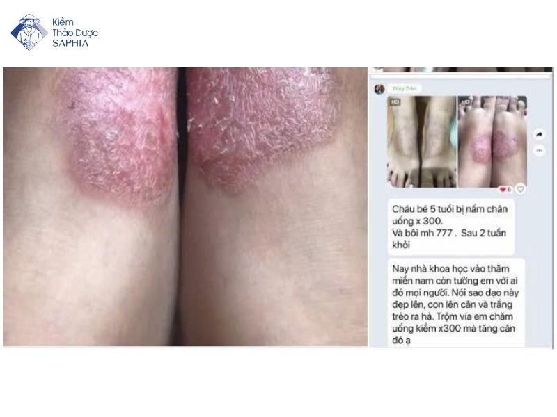 Nuoc Kiem Rua Vet Thuong 3