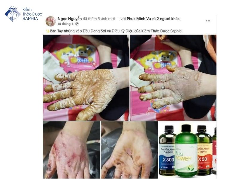 Nuoc Kiem Rua Vet Thuong 4